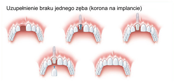 Uzupełnienie braku jednego zęba (korona na implancie)