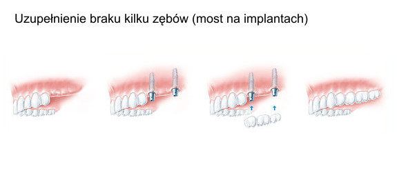 Uzupełnienie braku kilku zębów  (most na implantach)