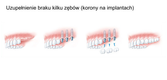 Uzupełnienie braku kilku zębów (korony na implantach)