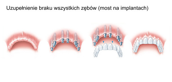 Uzupełnienie braku wszystkich zębów (most na implantach)