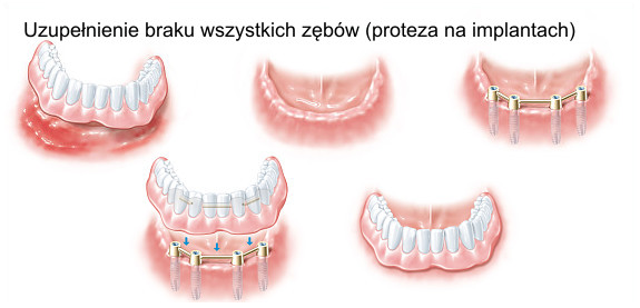Uzupełnienie braku wszystkich zębów (proteza na implantach)